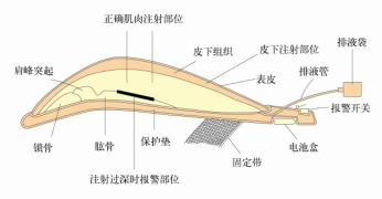 高级电子上臂肉注射训练模型