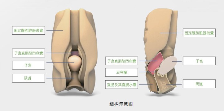 阴道后穹窿穿刺模型	