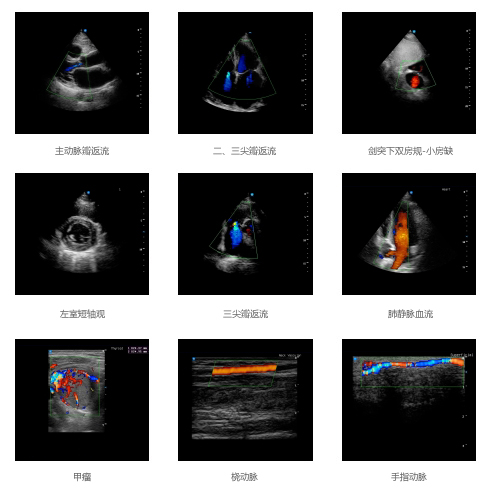 全数字彩色多普勒超声诊断系统