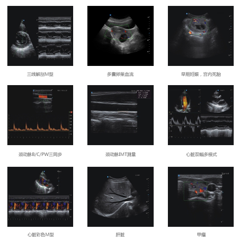 全数字彩色多普勒超声诊断系统