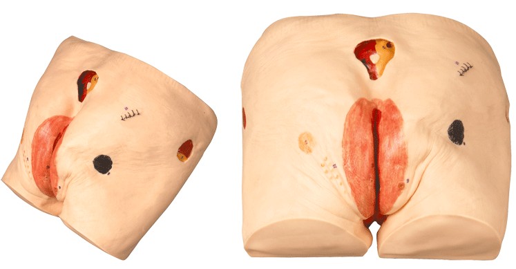 高级压疮（褥疮）护理模型